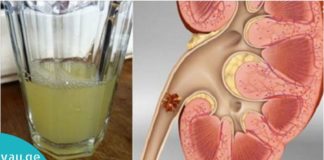 მოიშორეთ თირკმელებიდან კენჭები ამ სასმელის დახმარებით. მარტივი და ეფექტურია