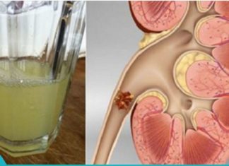 მოიშორეთ თირკმელებიდან კენჭები ამ სასმელის დახმარებით. მარტივი და ეფექტურია