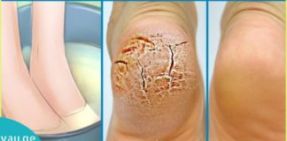 ნუ დახარჯავთ ბევრ ფულს პედიკურისთვის – გამოიყნეთ მხოლოდ სამზარეულოს ეს ორი ინგრედიენტი.