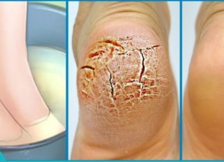 ნუ დახარჯავთ ბევრ ფულს პედიკურისთვის – გამოიყნეთ მხოლოდ სამზარეულოს ეს ორი ინგრედიენტი.