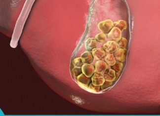 ჩინელებმა გაამჟღავნეს საიდუმლო! ნაღვლის ბუშტში კენჭების დაშლა 7-დღეში!