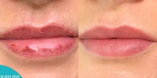 15 იდეა გამომშრალი ტუჩების დასატენიანებლად! აუცილებლად დაგაინტერესებთ…