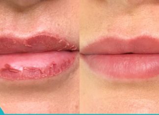 15 იდეა გამომშრალი ტუჩების დასატენიანებლად! აუცილებლად დაგაინტერესებთ…