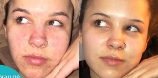 11 ნატურალური მეთოდი, რომელიც დაგეხმარებათ აკნეს დამარცხებაში!