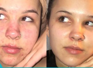 11 ნატურალური მეთოდი, რომელიც დაგეხმარებათ აკნეს დამარცხებაში!