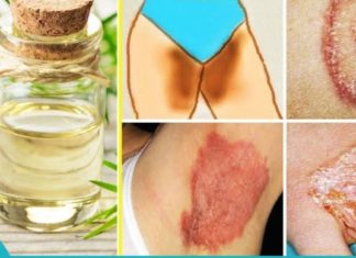 სახლში მოზადებული მეთოდი კანის სოკოვანი დაავადების (დერმატომიკოზის) სამკურნალოდ..