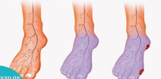 სისხლის ცუდი მიმოქცევა და ცივი ფეხები: გამომწვევი მიზეზები და მკურნალობის მეთოდები