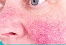 როგორ დავაღწიოთ თავი კუპეროზის დაავადებას?!