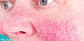 როგორ დავაღწიოთ თავი კუპეროზის დაავადებას?!