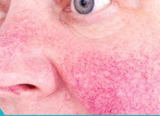 როგორ დავაღწიოთ თავი კუპეროზის დაავადებას?!