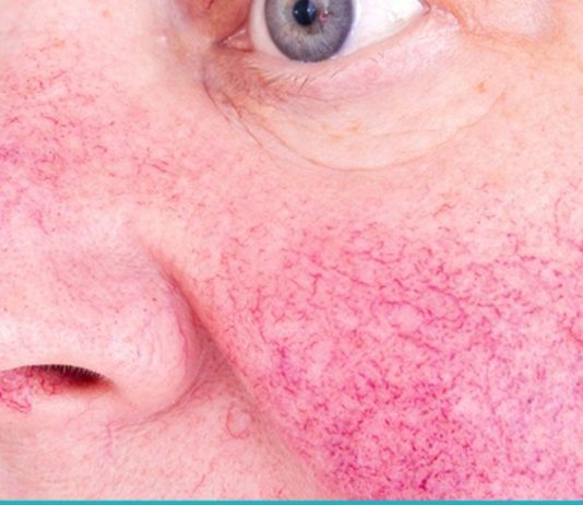 როგორ დავაღწიოთ თავი კუპეროზის დაავადებას?!