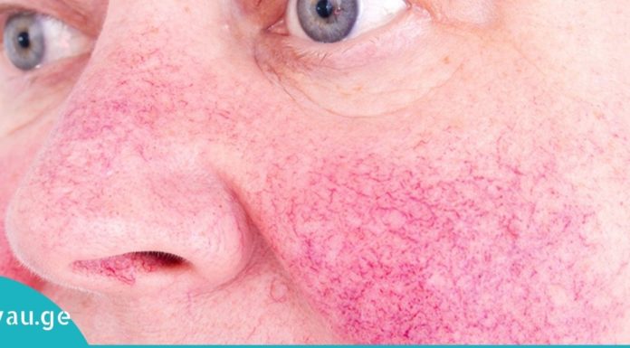 როგორ დავაღწიოთ თავი კუპეროზის დაავადებას?!