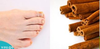 გამოიყენეთ დარიჩინი ამ გზით და ფეხისა ხელების სოკო არასდროს შეგაწუხებთ.