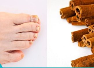 გამოიყენეთ დარიჩინი ამ გზით და ფეხისა ხელების სოკო არასდროს შეგაწუხებთ.