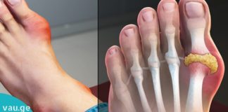 პოდაგრას მოცილება ბუნებრივი მეთოდით!