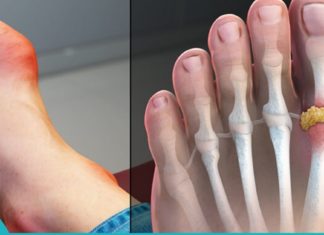 პოდაგრას მოცილება ბუნებრივი მეთოდით!