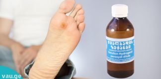 როგორ მოვიშოროთ მეჭეჭები წყალბადის ზეჟანგის გამოყენებით.