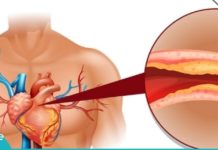 ნუ დახარჯავთ ბევრ ფულს ქოლესტერინისა და წნევის დამწევი წამლებისთვის. სცადეთ ძველი მეთოდები!