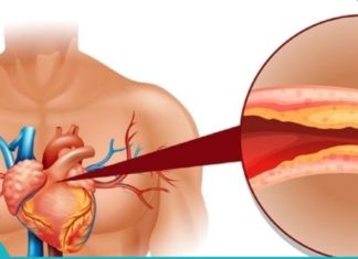ნუ დახარჯავთ ბევრ ფულს ქოლესტერინისა და წნევის დამწევი წამლებისთვის. სცადეთ ძველი მეთოდები!