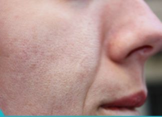 დაემშვიდობეთ გაფართოებულ ფორებს ამ ინგრედიენტის გამოყენებით!