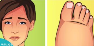 6 რამ რაც სხეულში სითხის შეკავებას იწვევს. როგორ ავიცილოთ ეს თავიდან!