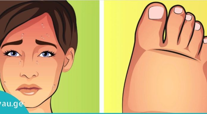 6 რამ რაც სხეულში სითხის შეკავებას იწვევს. როგორ ავიცილოთ ეს თავიდან!