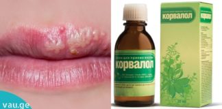ჰერპესის მკურნალობის საუკეთესო მეთოდი-კორვალოლი!