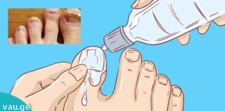 “სოკოს მკვლელი”- ასე ეწოდება საშუალებას, რომელიც სამუდამოდ დაგავიწყებთ ფრჩხილის სოკოს