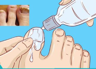 “სოკოს მკვლელი”- ასე ეწოდება საშუალებას, რომელიც სამუდამოდ დაგავიწყებთ ფრჩხილის სოკოს