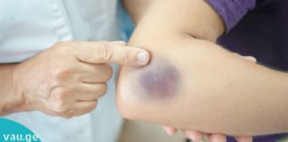 გაიქრეთ სისხლჩაქცევები მარილის დახმარებით. აი, როგორ უნდა გააკეთოთ ეს