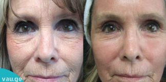 სახის 4 მარტივი ნიღაბი ნაოჭების წინააღმდეგ