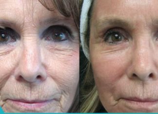 სახის 4 მარტივი ნიღაბი ნაოჭების წინააღმდეგ