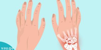 ართრიტი ძალიან მტანჯავდა სანამ ეს მეთოდი არ აღმოვაჩინე!