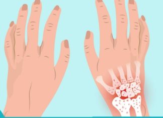 ართრიტი ძალიან მტანჯავდა სანამ ეს მეთოდი არ აღმოვაჩინე!