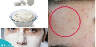 როგორ შეუძლია ასპირინის ორ ტაბლეტს დაგეხმაროთ ლაქების, ნაოჭების და ნაწიბურების მოცილებაში.