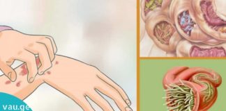 თუ ეს სიმპტომები გაქვთ, ნაწლავებში პარზიტებია.