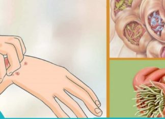 თუ ეს სიმპტომები გაქვთ, ნაწლავებში პარზიტებია.