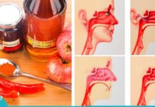 როგორ კლავს სინუსის ინფექციას რამდენიმე წუთში ვაშლის ძმარი!