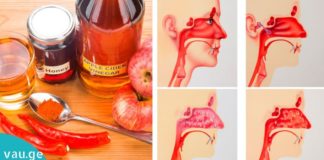 როგორ კლავს სინუსის ინფექციას რამდენიმე წუთში ვაშლის ძმარი!