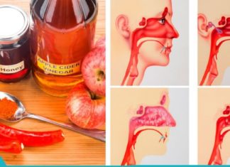 როგორ კლავს სინუსის ინფექციას რამდენიმე წუთში ვაშლის ძმარი!