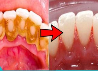 თქვენ შეგიძლიათ იყოთ საკუთარი თავის სტომატოლოგი. მოიშორეთ კბილებიდან ქვები სახლის პირობებში.