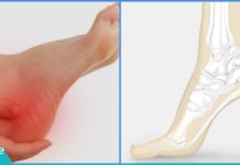 როგორ შევიმსუბუქოთ ქუსლების ტკივილი?!