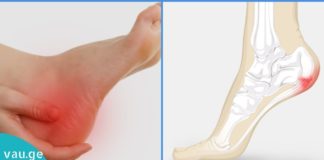 როგორ შევიმსუბუქოთ ქუსლების ტკივილი?!