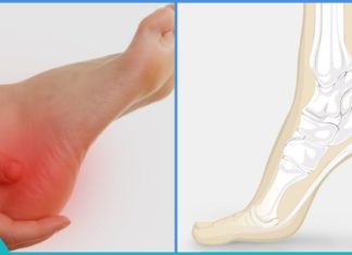 როგორ შევიმსუბუქოთ ქუსლების ტკივილი?!