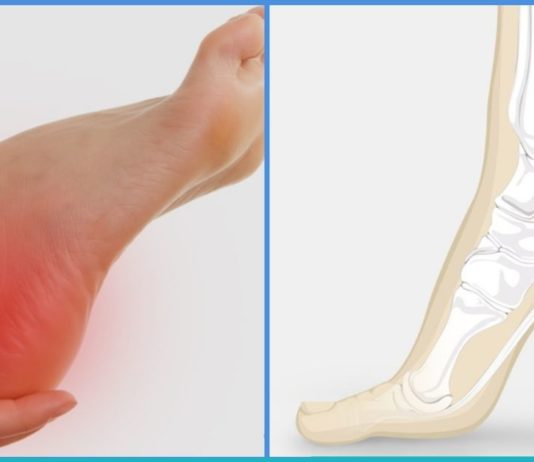 როგორ შევიმსუბუქოთ ქუსლების ტკივილი?!