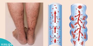 ღრმა ვენური თრომბოზის მიზეზები, სიმპტომები და მკურნალობის 5 ბუნებრივი მეთოდი.