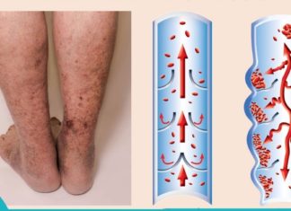 ღრმა ვენური თრომბოზის მიზეზები, სიმპტომები და მკურნალობის 5 ბუნებრივი მეთოდი.