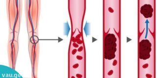 8 პროდუქტი, რომელიც ათხელებს სისხლს და ახდენს თრომბოზის პროფილაქტიკას.