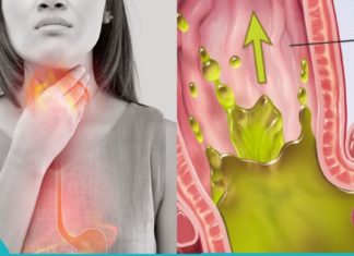 იტანჯებით გასტრო-ეზოფაგალური რეფლუქსის დაავადებით? ეს სახლში დამზადებული სასმელი გადაჭრის თქვენს პრობლემას უმოკლეს დროში!