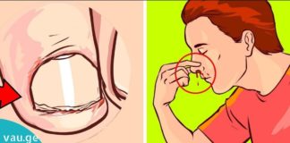 9 ნიშანი იმისა, რომ გაქვთ C ვიტამინის ნაკლებობა.